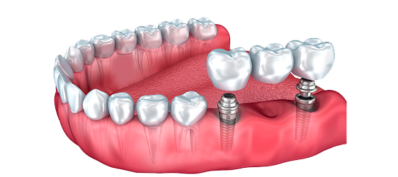 IMPLANTE DENTARIO pôntico