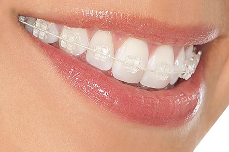 aparelho ortodonticos ceramico