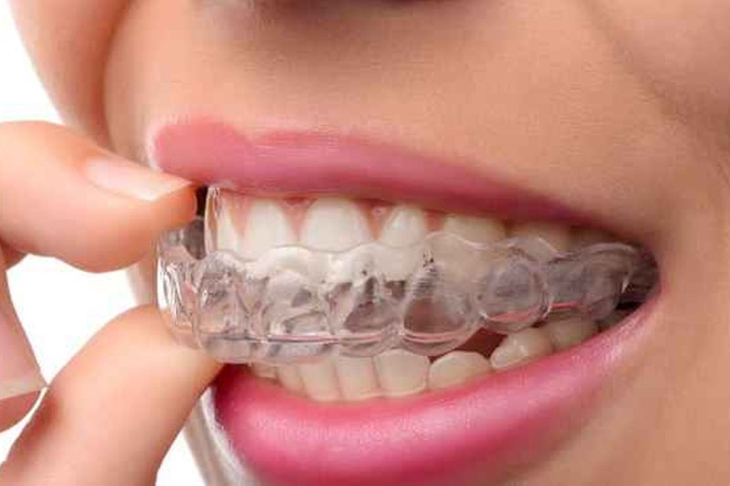 aparelho ortodonticos invisalign
