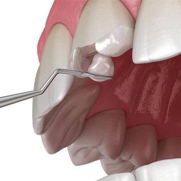 restauração dentaria