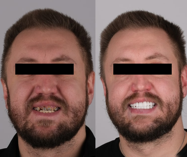 antes-e-depois-1.png