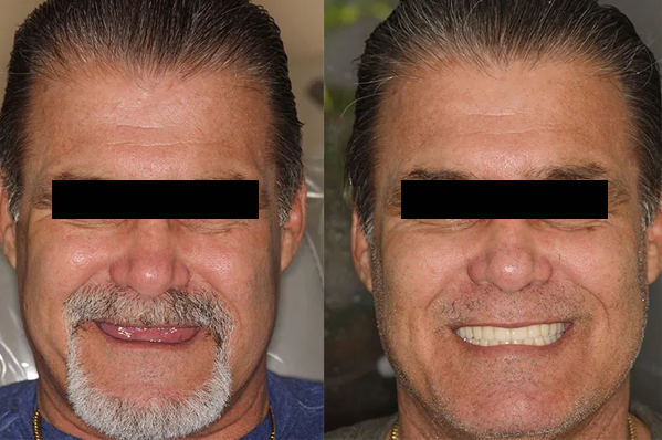 antes-e-depois-2.png
