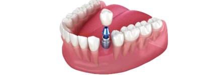 IMPLANTES DENTARIOS UNITÁRIOS