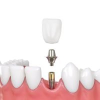 IMPLANTES DENTARIOS UNITÁRIOS